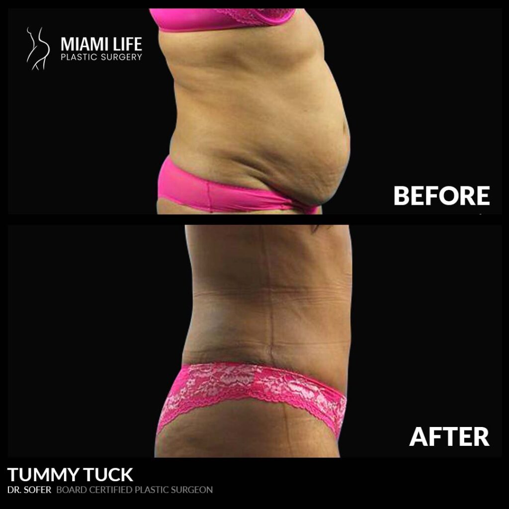 tummy tuck