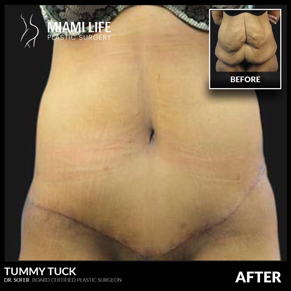 tummy tuck