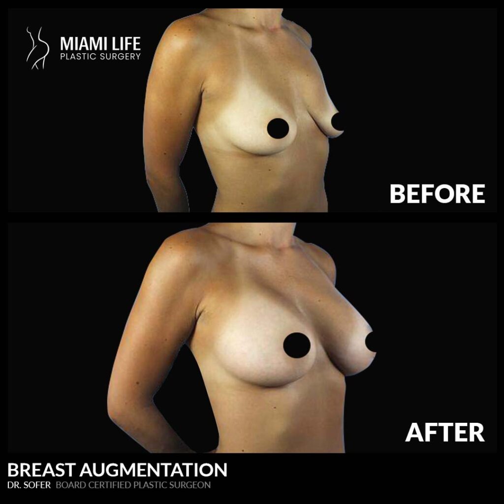 breast lift