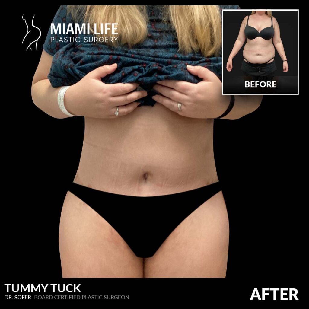 tummy tuck miami