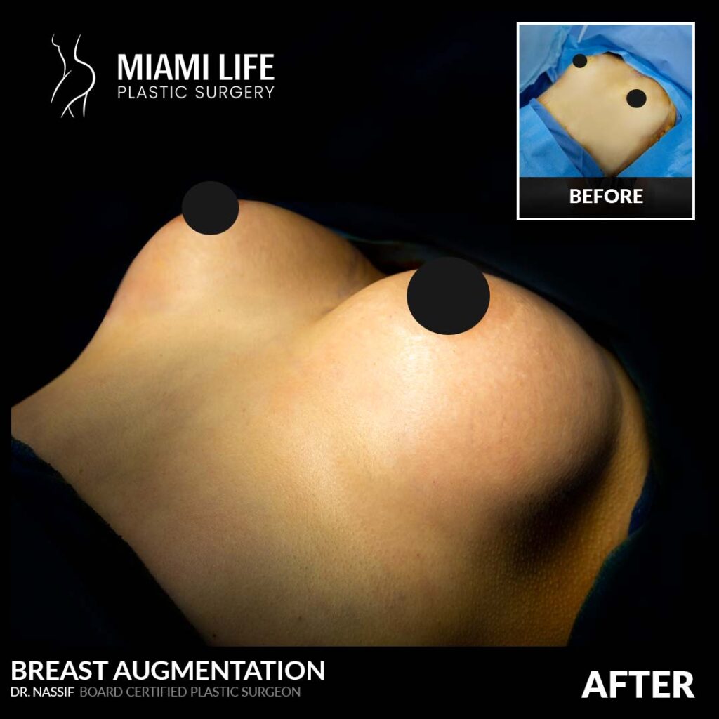 breast augmentation