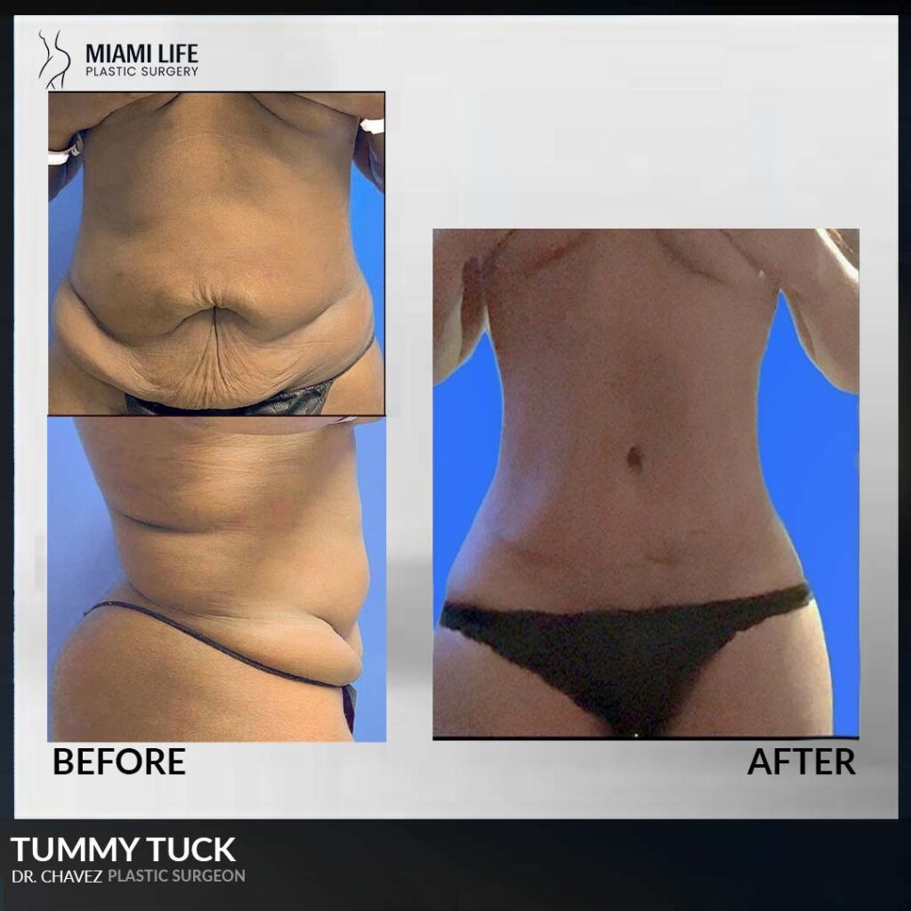 tummy tuck