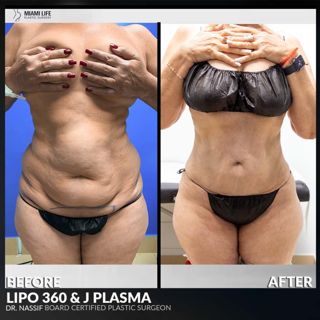 liposuction surgery