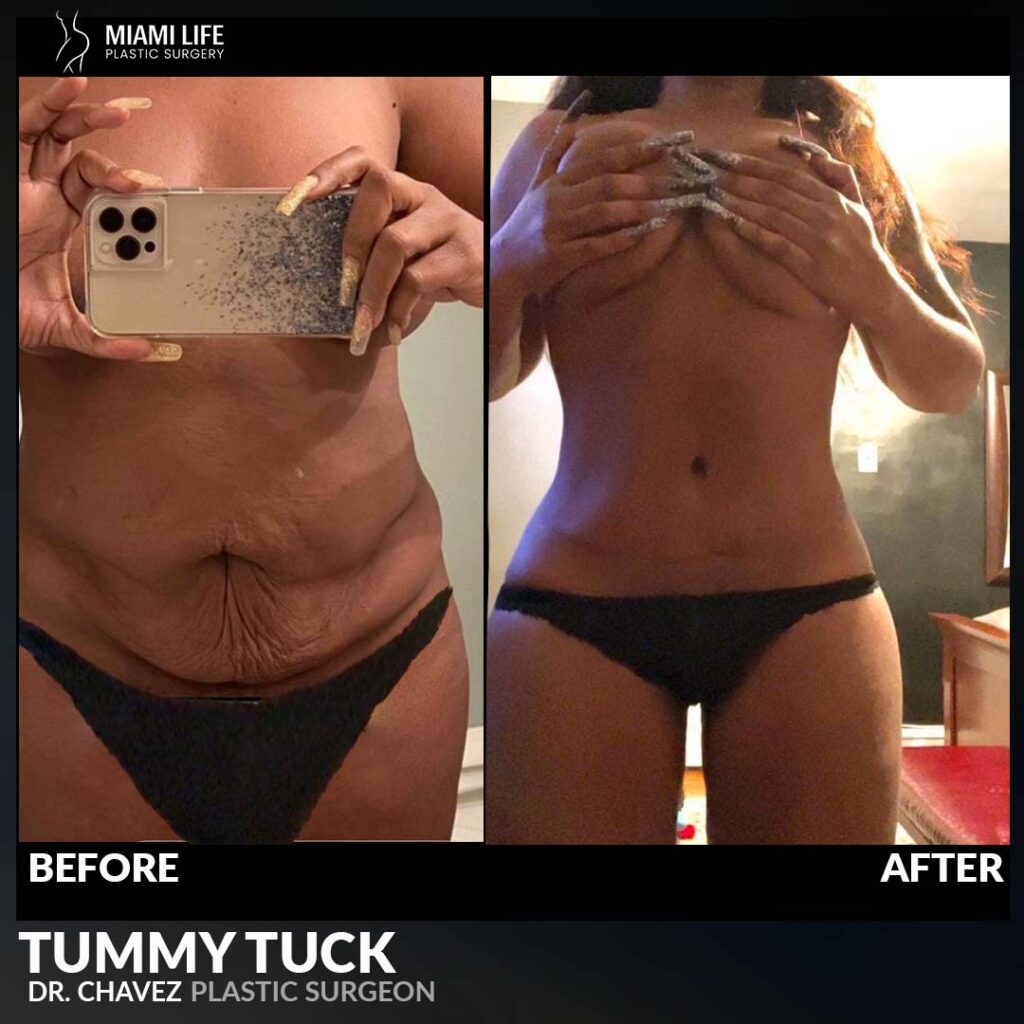 tummy tuck cost