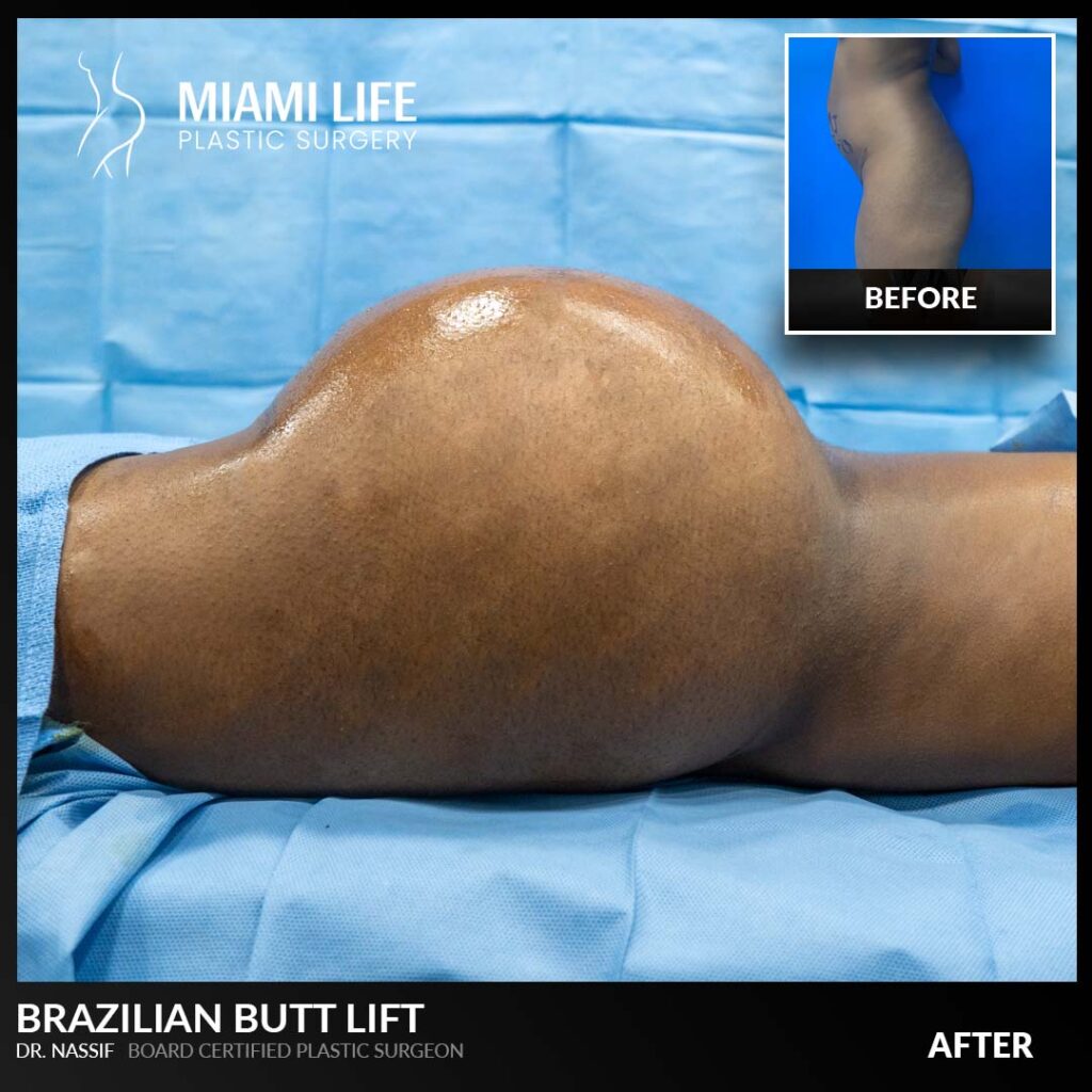 brazilian butt lift