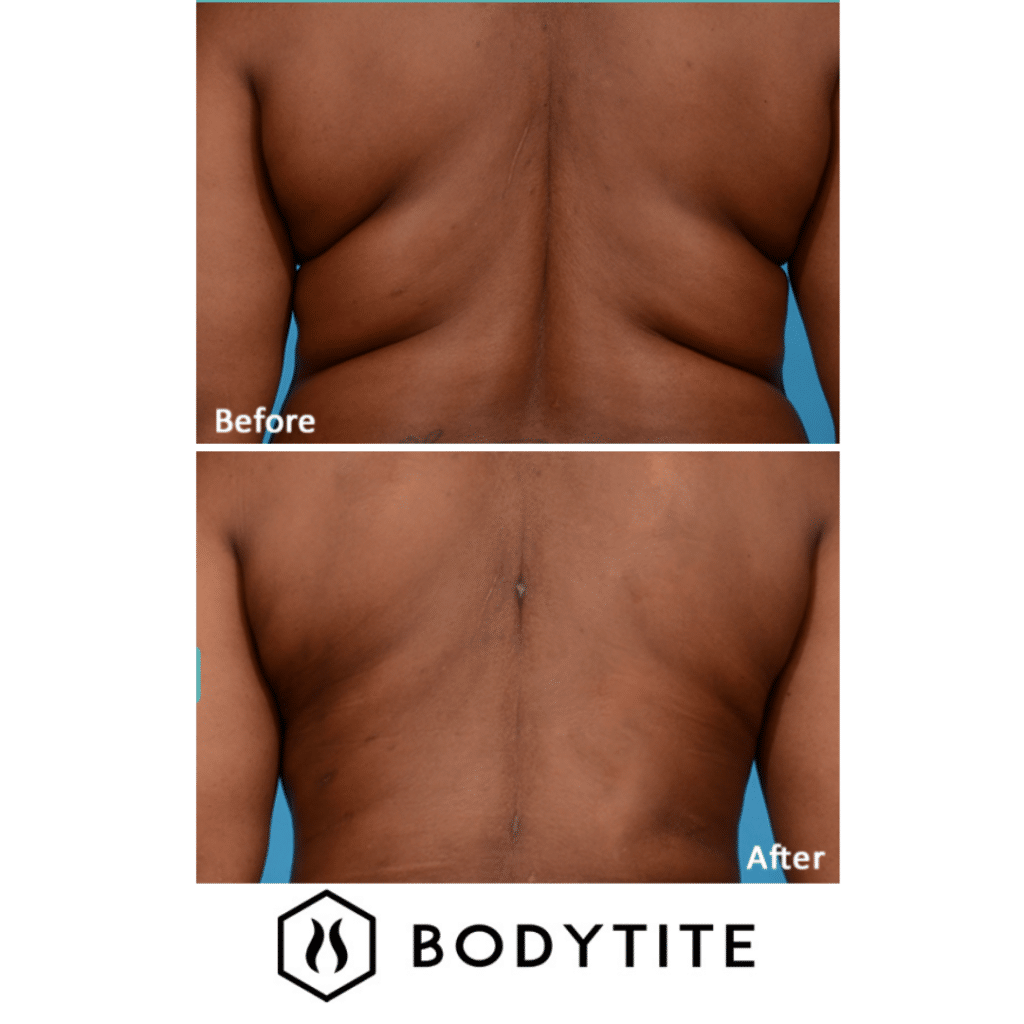 bodytite-2