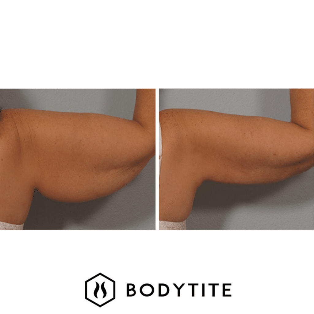 bodytite-3